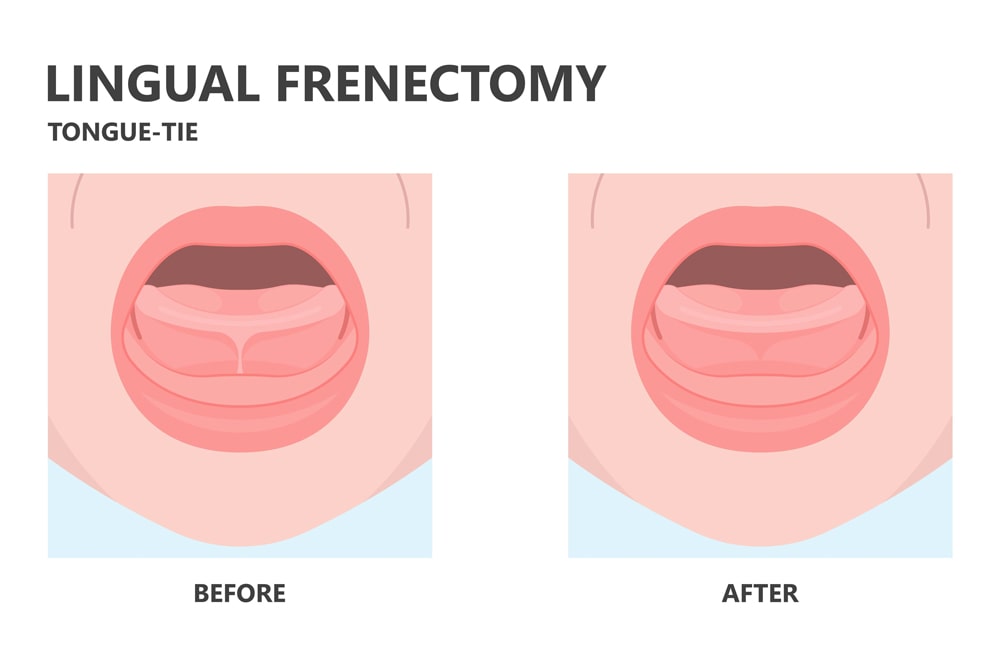 Does My Child Need a Lingual Frenectomy?