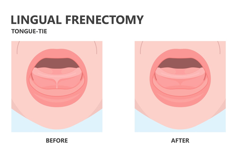 Lingual Frenectomy Before And After Lingual Frenectomy Before And After