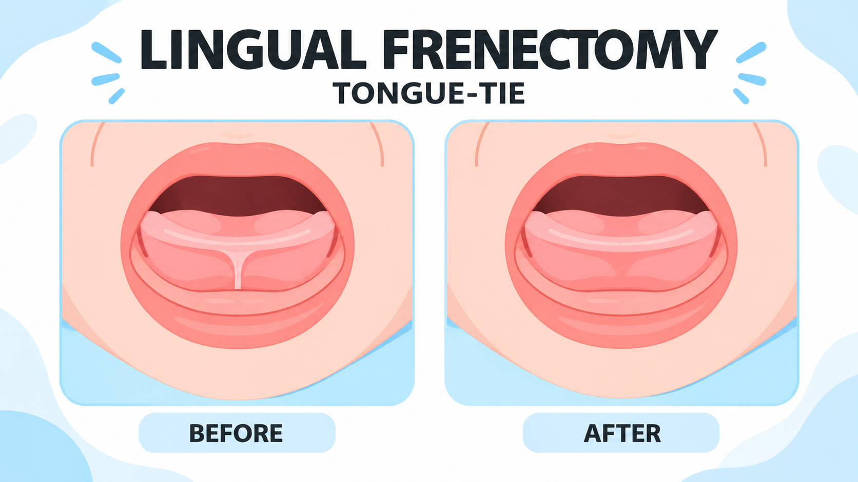 Does My Child Need a Lingual Frenectomy?