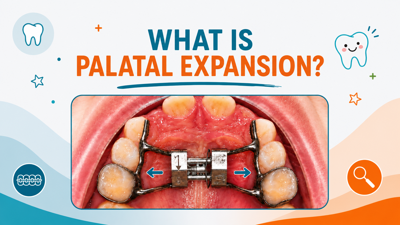 Why Early Palatal Expansion May Matter for Your Child